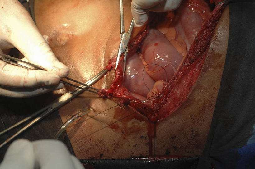 横图,俯视,室内,特写,安全,不锈钢,镊子,防护,手套,摄影,保护,部分,手术,手术室,拼接,保险,医疗工具,外科医生,保全,周全,安稳,安定,缝合,防护手套,平安,脾脏,彩图,高角度拍摄