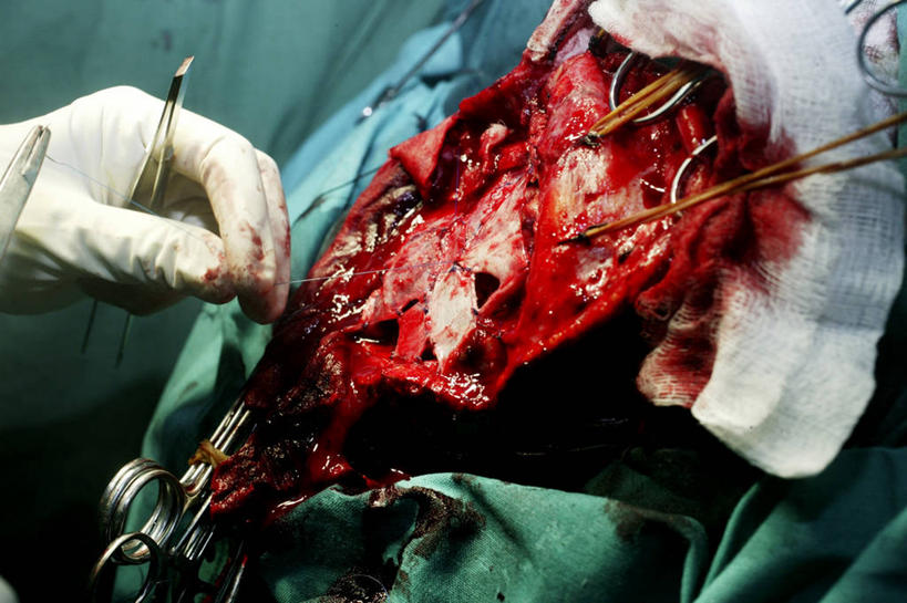 头,手,一个人,医院,横图,室内,特写,白天,安全,苏丹,镊子,防护,拿着,手套,血液,摄影,皮肤,保护,部分,手术,伤口,准确,拼接,解剖刀,保险,外科医生,保全,周全,安稳,安定,缝合,防护手套,技能,平安,头部,彩图,缝线