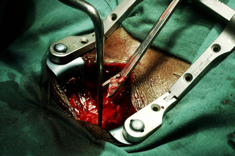 无人,医院,横图,室内,特写,白天,安全,苏丹,镊子,防护,手套,血液,摄影,皮肤,保护,手术,伤口,手术室,保险,外科医生,保全,周全,安稳,安定,防护手套,平安,脊柱,彩图,背痛,椎间盘突出