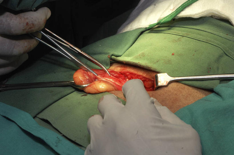 成年人,手,两个人,病人,横图,室内,特写,安全,不锈钢,防护,拿着,手套,血液,摄影,皮肤,修理,保护,部分,手术,准确,保险,外科医生,腹股沟,保全,周全,安稳,安定,防护手套,肠道,消化道,吸收,消化管,消化,排泄,手术器械,摄取,平安,彩图,消化腺,转运,消化系统,腹股沟疝