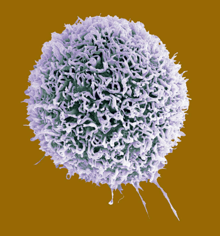 无人,竖图,俯视,室内,特写,白天,仪器,微生物,橙色背景,检查,反射,分析,科学,医学,细胞,显微镜,紫色,观察,清晰,探索,放大,观看,仔细,透镜,疾病,生物学,凸透镜,聚焦,关注,肿瘤,乳腺癌,癌症,光学,清楚,恶性肿瘤,显微图片,彩图,高角度拍摄,扫描电镜,扫描电子显微镜,乳腺肿瘤,乳癌