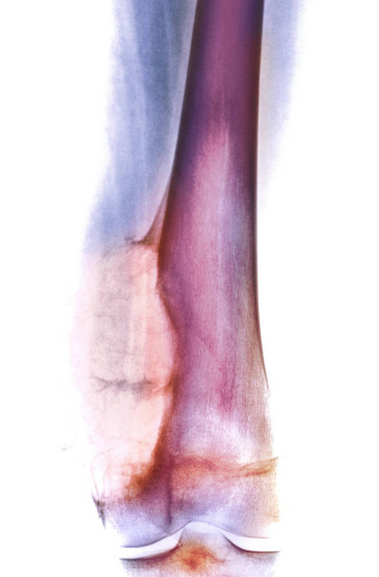 骨骼,无人,竖图,插画,x光片,室内,白天,白色背景,正面,数码,科技,阴影,辐射,科学,网络,医学,骨头,高光,几何,计算机图形,合成,图画,画,粉色,电脑合成图,数码合成图,骨架,医疗,疾病,科学技术,x射线,合成图,肿瘤,x光,漫画,癌症,写实,具体,具象,彩图,良性肿瘤,电磁波,电磁辐射,动脉瘤样骨囊肿,骨肿瘤