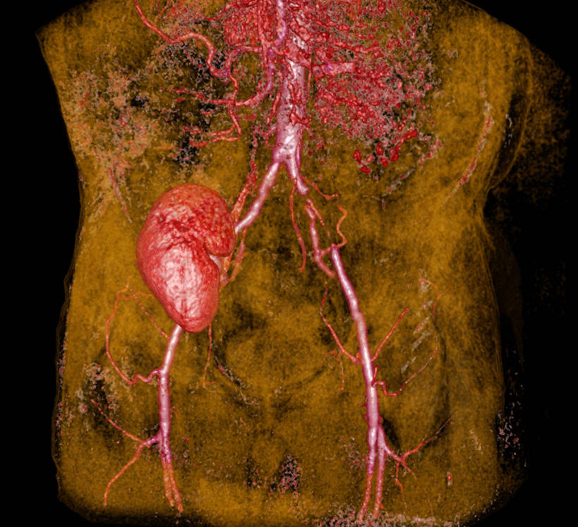 无人,横图,插画,室内,白天,正面,机器,数码,科技,阴影,黑色背景,网络,医学,高光,几何,计算机图形,合成,图画,设备,画,红色,电脑合成图,数码合成图,医疗,疾病,合成图,核磁共振,漫画,核磁共振成像,写实,具体,具象,磁共振成像,核磁共振技术,彩图,髂动脉狭窄