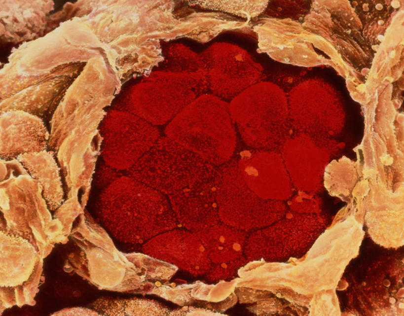 无人,横图,插画,室内,白天,正面,数码,科技,微生物,阴影,科学,网络,医学,细胞,高光,几何,计算机图形,合成,图画,画,粉色,橙色,电脑合成图,数码合成图,疾病,生物学,合成图,肿瘤,漫画,癌症,癌细胞,写实,具体,具象,恶性肿瘤,肺癌,彩图,肺腺癌,肺肿瘤